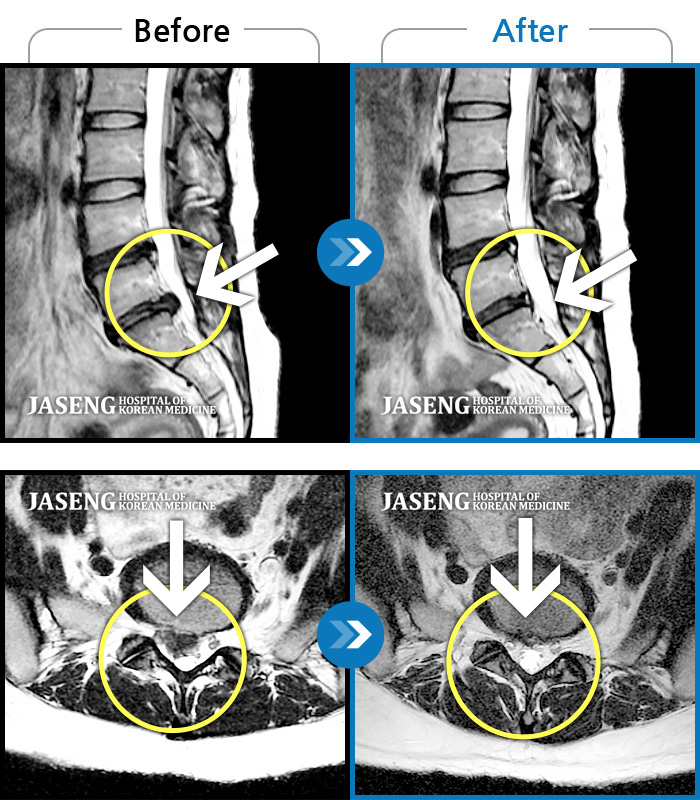 대전자생한방병원 치료사례 MRI로 보는 치료결과-허리통증, 우측 엉덩이 통증