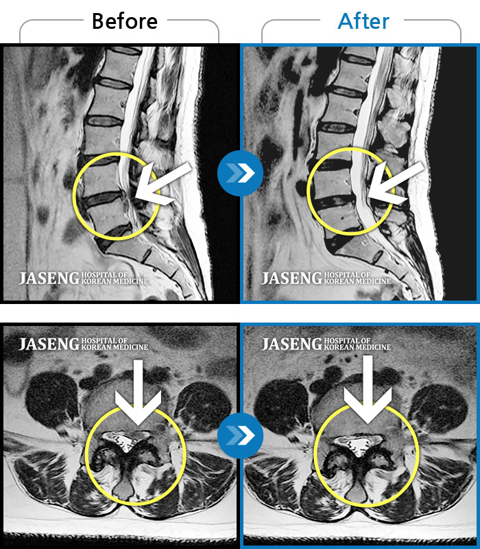 대전자생한방병원 치료사례 MRI로 보는 치료결과-갑작스러운 허리 및 왼쪽 하지 통증으로 내원