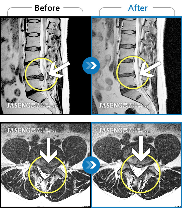 대전자생한방병원 치료사례 MRI로 보는 치료결과- 허리 및 왼쪽 하지 통증 및 저림