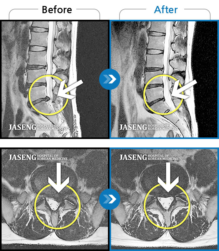 대전자생한방병원 치료사례 MRI로 보는 치료결과-오른쪽 다리가 저리고 아프며 골반이 좌측으로 편위된 상태였습니다. 