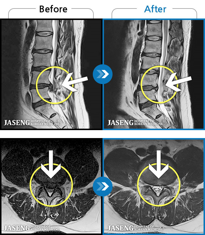 �ڻ��ѹ溴�� ġ���� MRI�� ���� ġ����-���� ����ο��� �����߰��� ������ ������.
