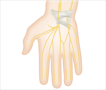 대전자생한방병원 기타관절질환 손목터널증후군-손목터널증후군에 관련된 이미지 입니다.
