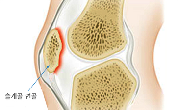 대전자생한방병원 무릎질환 슬개골연골연화증-슬개골 연골이 위치해 있는 무릎 설명 이미지