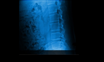 대전자생한방병원 허리질환 척추후만증-척추후만증에 관련된 이미지 입니다.