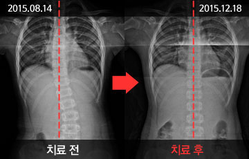 대전자생한방병원 청소년척추 체형교정&척추측만증- 치료 전후 사례 이미지