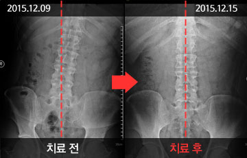 대전자생한방병원 청소년척추 체형교정&척추측만증- 치료 전후 사례 이미지