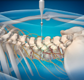 대전자생한방병원 허리치료법 신경근회복술-신경근회복술의 특징 두번째 관련 사진 입니다.