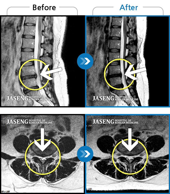 인천자생한방병원 치료 전후 MRI 비교 이미지