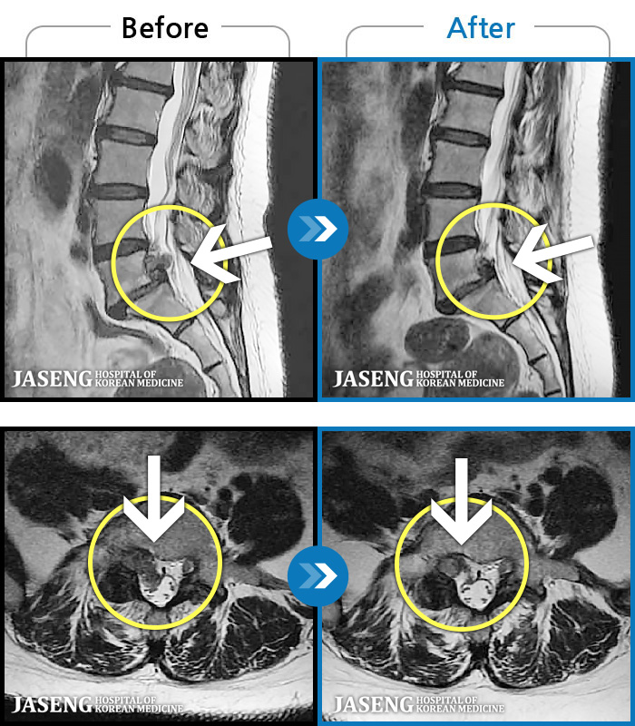 보라매자생한방병원 치료 전후 MRI 비교 이미지