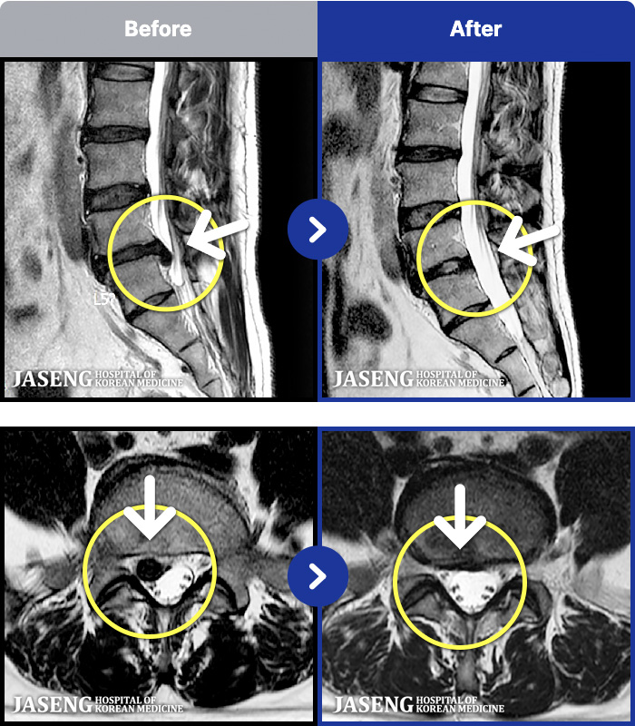 자생한방병원 치료 전후 MRI 비교 이미지