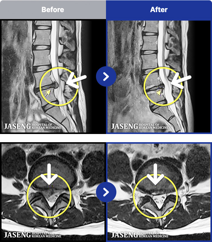 광주자생한방병원 치료 전후 MRI 비교 이미지
