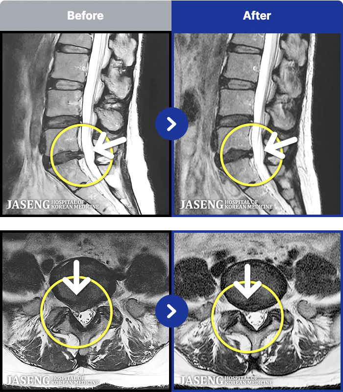 자생한방병원 치료 전후 MRI 비교 이미지