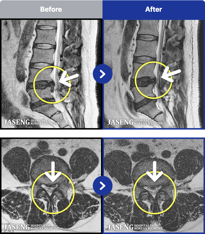 인천자생한방병원 치료 전후 MRI 비교 이미지