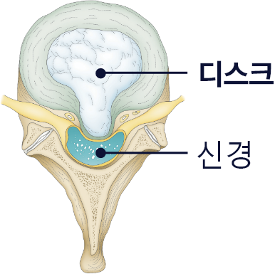 허리디스크로 디스크가 신경을 압박하는 척추 단면도