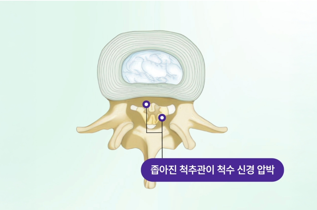 좁아진 척추관이 척수 신경을 압박하는 일러스트 