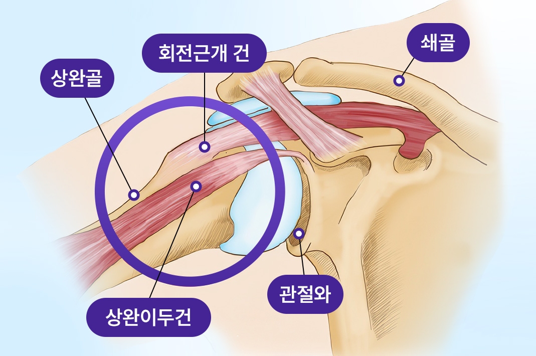 어깨뼈와 힘줄이 부딪혀 염증이 생긴 모습을 나타낸 일러스트